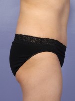 Liposuction Before and after photo