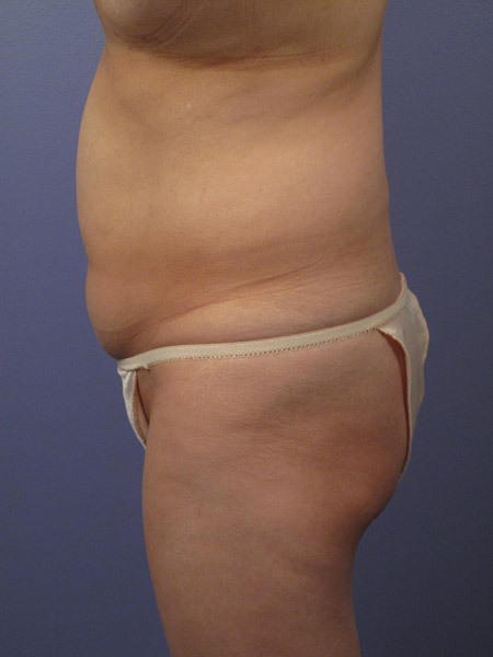 Liposuction before and after photo