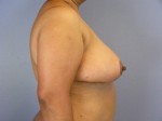 Liposuction Before and after photo