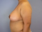 Liposuction Before and after photo