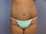 Liposuction Before and after photo