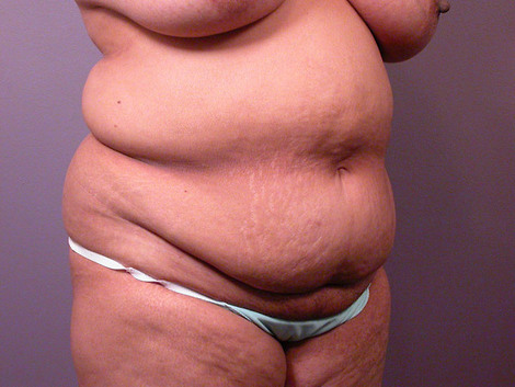 Liposuction before and after photo