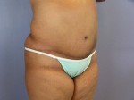 Liposuction Before and after photo