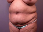 Liposuction Before and after photo