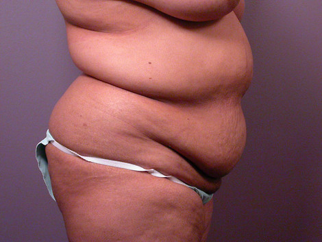 Liposuction before and after photo