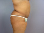 Liposuction Before and after photo