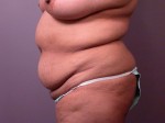 Liposuction Before and after photo