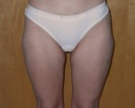 Liposuction Before and after photo