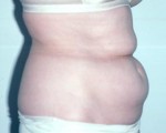 Liposuction Before and after photo