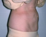 Liposuction Before and after photo