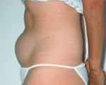 Liposuction Before and after photo