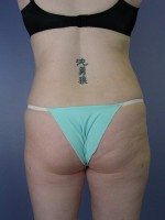 Liposuction Before and after photo