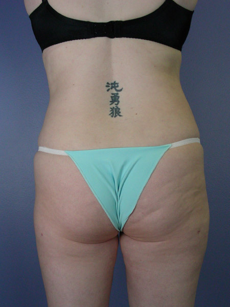 Liposuction before and after photo