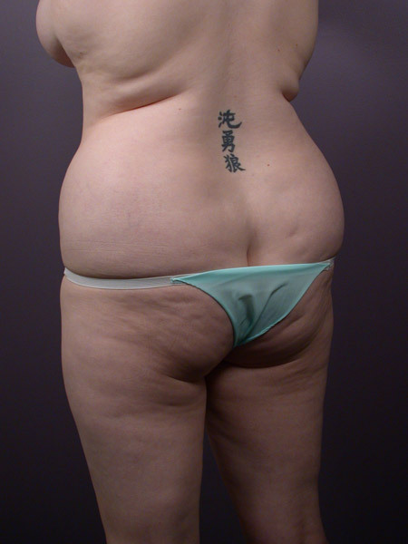 Liposuction before and after photo