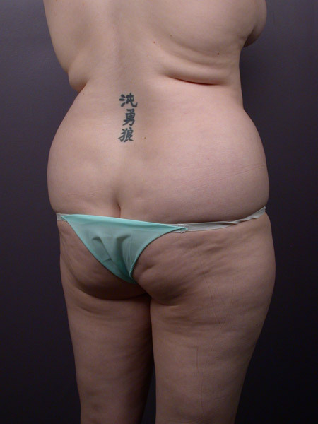 Liposuction before and after photo