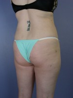 Liposuction Before and after photo