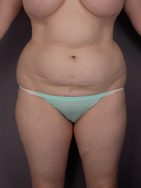 Liposuction before and after photo