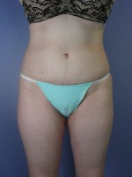 Liposuction Before and after photo