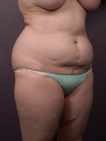 Liposuction Before and after photo