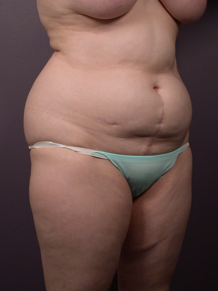 Liposuction before and after photo