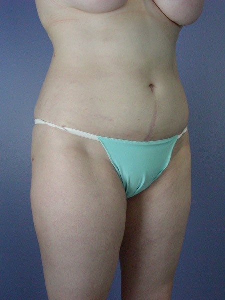 Liposuction before and after photo