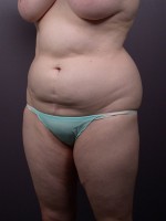 Liposuction Before and after photo