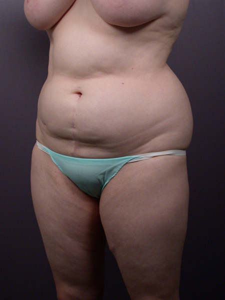 Liposuction before and after photo