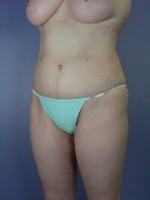 Liposuction Before and after photo