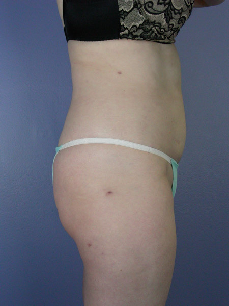 Liposuction before and after photo