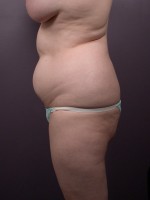 Liposuction Before and after photo