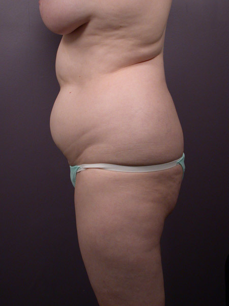 Liposuction before and after photo