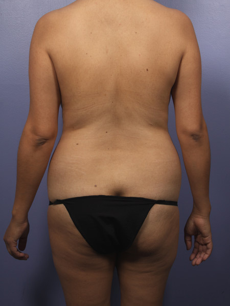 Liposuction before and after photo