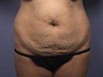 Liposuction Before and after photo