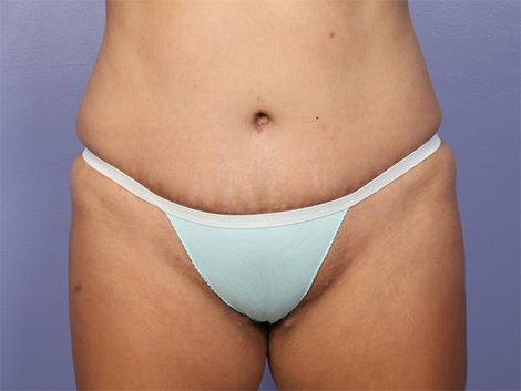 Liposuction before and after photo