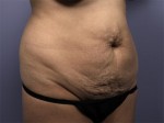 Liposuction Before and after photo