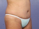 Liposuction Before and after photo