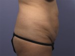 Liposuction Before and after photo