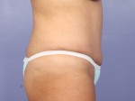 Liposuction Before and after photo