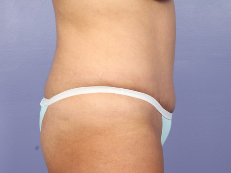 Liposuction before and after photo