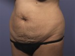 Liposuction Before and after photo