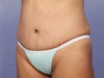 Liposuction Before and after photo