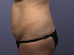 Liposuction Before and after photo