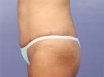 Liposuction Before and after photo