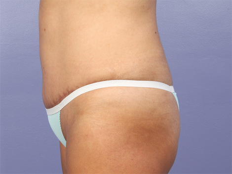 Liposuction before and after photo