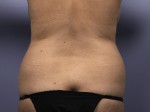 Liposuction Before and after photo