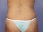 Liposuction Before and after photo