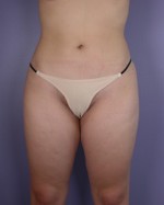 Liposuction Before and after photo