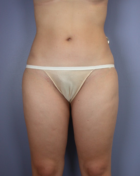 Liposuction before and after photo