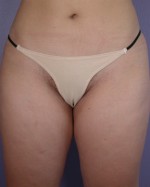 Liposuction Before and after photo