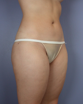 Liposuction before and after photo